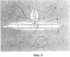 Способ ушивания сквозной вертикальной раны века с повреждением края (патент 2535455)