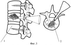 Способ пластики тела сломанного позвонка (патент 2411017)