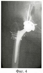 Способ продольной остеотомии проксимального отдела бедренной кости при установке бедренного компонента тазобедренного сустава (патент 2411013)