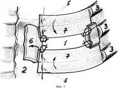 Костно-пластический способ закрытия дефекта ребер грудной клетки (варианты) (патент 2551617)