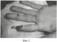 Способ кожной пластики при циркулярном дефекте мягких тканей дистальной фаланги пальца кисти (патент 2474391)