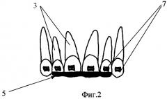 Способ лечения глубокого прикуса (патент 2363417)