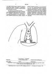 Способ холедохоеюностомии (патент 1801384)