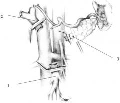 Способ панкреатодуоденальной резекции при местнораспространенном раке периампулярной области с опухолевой инвазией воротной и верхней брыжеечной вены (патент 2336832)