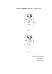 Способ устранения сквозного дефекта носа (патент 2580660)