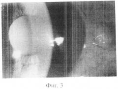 Способ лечения воспалительных состояний переднего отрезка глаза (патент 2513597)
