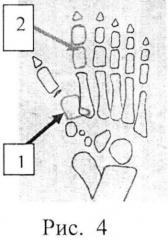 Способ хирургического лечения сложной формы полного удвоения первого луча стопы у детей (патент 2556786)