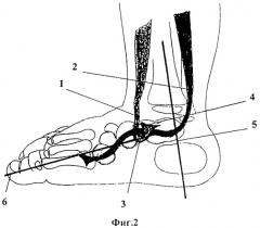 Способ хирургического лечения врожденной плоско-вальгусной деформации стоп у детей (патент 2543853)