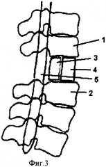 Способ хирургического лечения последствий переломов позвоночника (патент 2279859)