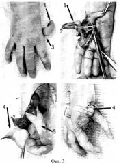 Способ реконструкции кисти у детей с гипоплазией первого пальца (патент 2269962)