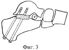 Способ коррекции посттравматической вальгусной деформации заднего отдела стопы (патент 2405485)