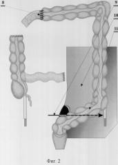 Способ илеоцекоцистопластики (патент 2323688)
