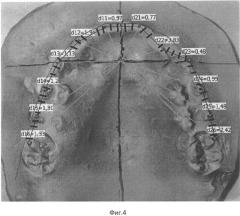 Способ определения и планирования направления и величины перемещения зубов при ортодонтическом лечении (патент 2538620)