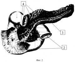 Способ продольного панкреатоэнтероанастомоза (патент 2296517)