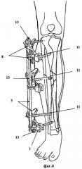 Аппарат для лечения больных с сочетанными повреждениями голени и стопы (патент 2476181)