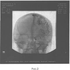 Способ лечения артериовенозных мальформаций головного мозга (патент 2534233)