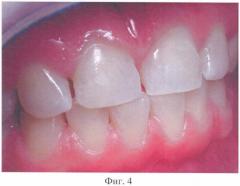 Способ восстановления коронковой части зубов, относящихся к группе резцов (патент 2441619)