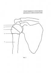 Способ хирургического лечения перелома проксимального отдела плечевой кости (патент 2652573)