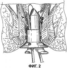 Хирургическое устройство для чрезанального доступа к прямой кишке пациента (патент 2445020)