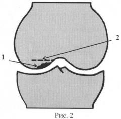 Способ выполнения субхондральной спицевой туннелизации бедренной кости при хондромаляции суставного хряща (патент 2454195)