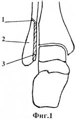 Способ артродеза голеностопного и подтаранного суставов (патент 2334480)