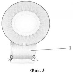 Способ комбинированного хирургического лечения глаукомы и катаракты (патент 2371149)