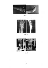 Способ лечения посттравматических деформаций дистального отдела лучевой кости, сочетающихся с контрактурами кистевого сустава и суставов предплечья (патент 2585424)