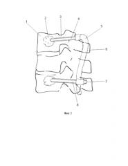 Способ перкутанной транспедикулярной стабилизации позвоночника в грудном и поясничном отделах (патент 2577940)