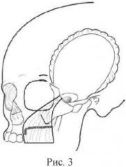 Способ хирургического лечения остеонекроза верхней челюсти (патент 2559915)