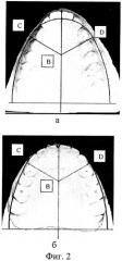 Планиметрический способ контроля коррекции верхней зубной дуги (патент 2386393)