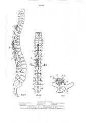 Устройство для коррекции искривлений позвоночника (патент 1424825)