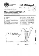 Способ лечения прогнатии нижней челюсти (патент 1175445)