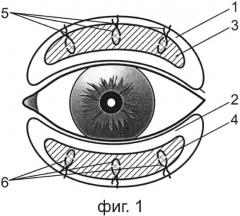 Способ хирургического лечения послеожогового выворота верхнего и нижнего век (патент 2578846)