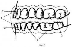 Зубные шины для массажа (патент 2306917)