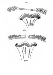 Способ лечения гигантских вентральных грыж (патент 1598977)