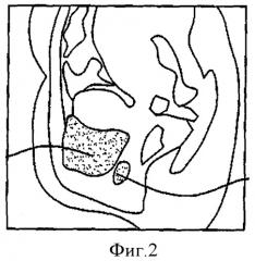 Аппликатор (варианты) и вкладыш тампона (патент 2417064)