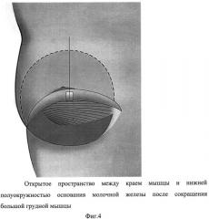 Способ формирования кармана для имплантата в двойственной плоскости при аугментационной маммопластике (патент 2498777)