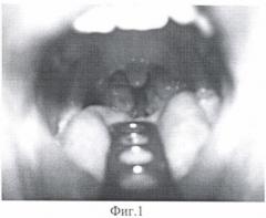 Способ лазирования миндаликовой ниши после лазерной тонзиллэктомии (патент 2377037)