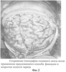 Способ фиксации головного мозга человека без вскрытия полости черепа (патент 2360612)