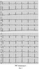 Способ электрокардиографической диагностики гипертрофии миокарда левого желудочка у больных артериальной гипертонией с избыточной массой тела (патент 2344754)
