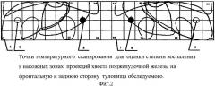 Способ исследования температурного режима поджелудочной железы при диагностике сахарного диабета 1-го типа (патент 2514529)