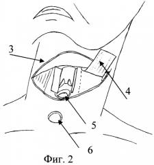 Способ хирургического лечения рака гортани (патент 2445014)
