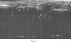 Способ ультразвуковой диагностики стадий болезни фрейберга (патент 2537891)