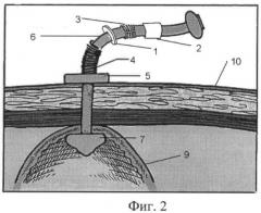 Устройство для гастростомии (патент 2442618)