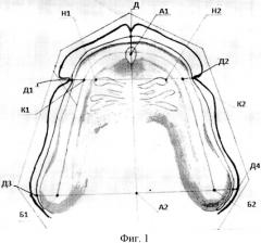 Способ диагностики атрофии беззубых челюстей (патент 2565816)