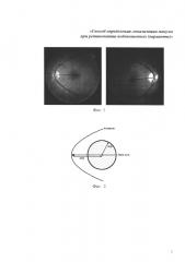 Способ определения локализации макулы при ретинопатии недоношенных (варианты) (патент 2645411)