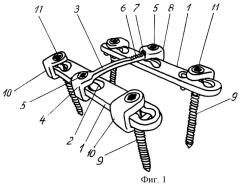 Устройство для заднего спондилодеза (патент 2246279)