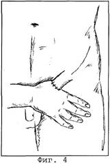 Способ реконструкции пальца кисти (патент 2297804)