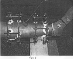 Способ лечения переломов длинных трубчатых костей (патент 2311155)