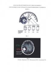 Способ предлучевой подготовки больных с опухолями в зоне прецентральной извилины головного мозга (патент 2632539)